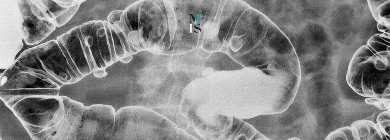 Diverticulitis vs Diverticulosis