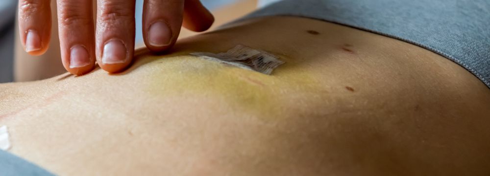 Woman carefully gets her surgical incisions checked after a laparoscopic surgery wondering how she can reduce risk of hernia